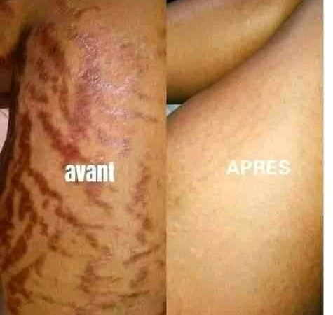 Soin de la peau